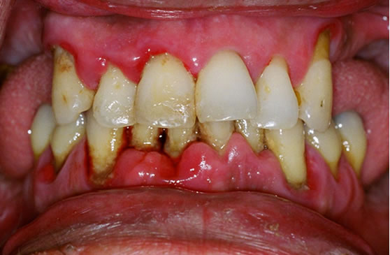 tartar on back of bottom teeth